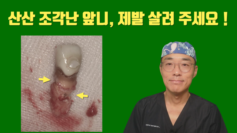 [불가능한 치아를 살린다] 산산 조각난 치아를 살려달라는 환자의 간절함이 살린 재식술 #재식술 #치아재식술 #최용훈원장