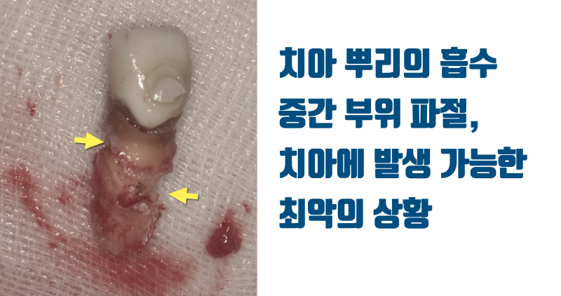 [불가능한 치아를 살린다] 산산 조각난 치아를 살려달라는 환자의 간절함이 살린 재식술 #재식술 #치아재식술 #최용훈원장 사진 3