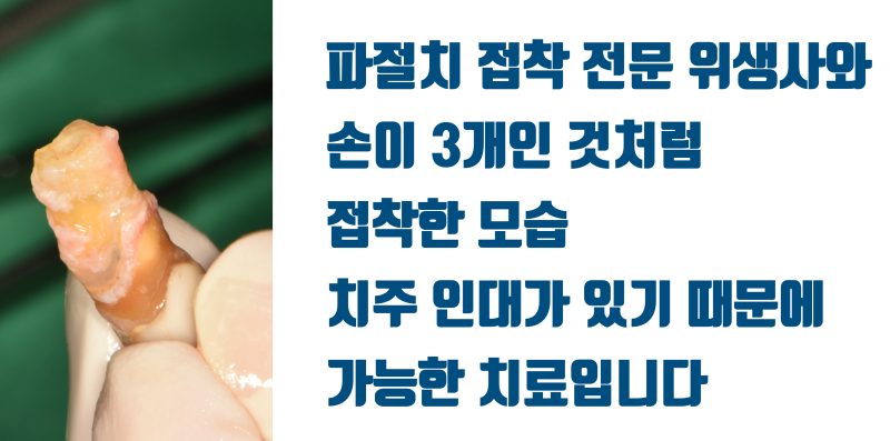 [불가능한 치아를 살린다] 산산 조각난 치아를 살려달라는 환자의 간절함이 살린 재식술 #재식술 #치아재식술 #최용훈원장 사진 5