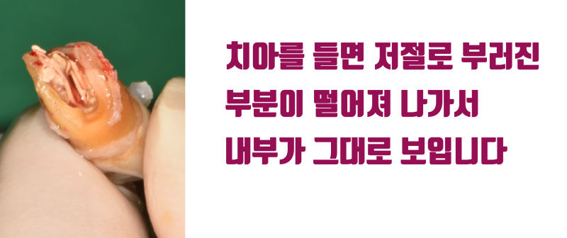 [불가능한 치아를 살린다] 산산 조각난 치아를 살려달라는 환자의 간절함이 살린 재식술 #재식술 #치아재식술 #최용훈원장 사진 4