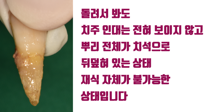 [흔들리는 치주 질환 치아 살리기] 누가 봐도 발치해야할 치아를 살린다 #재식술 #치주질환재식술 #최용훈원장