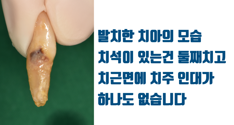 [흔들리는 치주 질환 치아 살리기] 누가 봐도 발치해야할 치아를 살린다 #재식술 #치주질환재식술 #최용훈원장 사진 3
