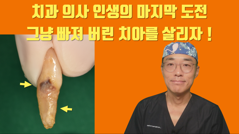 [흔들리는 치주 질환 치아 살리기] 누가 봐도 발치해야할 치아를 살린다 #재식술 #치주질환재식술 #최용훈원장