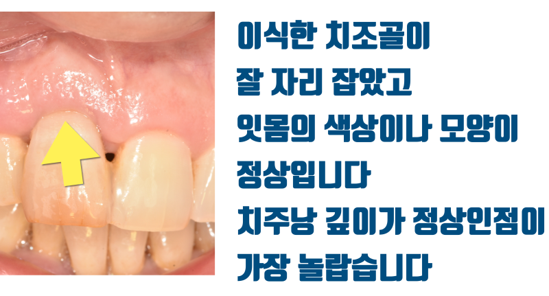 [흔들리는 치주 질환 치아 살리기] 누가 봐도 발치해야할 치아를 살린다 #재식술 #치주질환재식술 #최용훈원장 사진 6