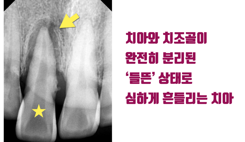 [흔들리는 치주 질환 치아 살리기] 누가 봐도 발치해야할 치아를 살린다 #재식술 #치주질환재식술 #최용훈원장 사진 2