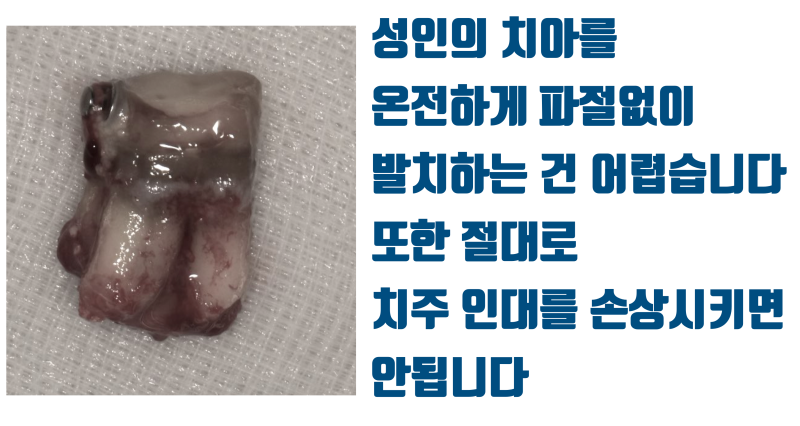 [인생 재식술 증례] 4시간 동안 발치 실패한 치아를 4분만에 발치 성공 #재식술 #치아재식술 #최용훈원장