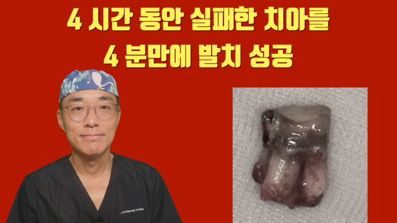 [인생 재식술 증례] 4시간 동안 발치 실패한 치아를 4분만에 발치 성공 #재식술 #치아재식술 #최용훈원장
