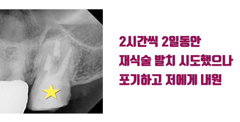 [인생 재식술 증례] 4시간 동안 발치 실패한 치아를 4분만에 발치 성공 #재식술 #치아재식술 #최용훈원장 사진 2