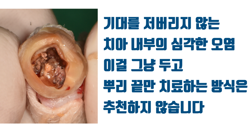 [이래서 실패했다] 숨어 있는 치아 내부의 문제를 반드시 찾아서 확실하게 해결해야 하는 이유 #재식술 #치아재식술 #최용훈원장 사진 2