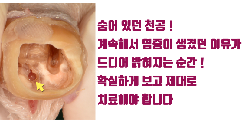 [이래서 실패했다] 숨어 있는 치아 내부의 문제를 반드시 찾아서 확실하게 해결해야 하는 이유 #재식술 #치아재식술 #최용훈원장 사진 3