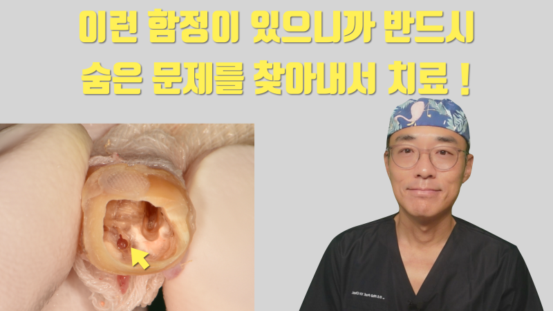 [이래서 실패했다] 숨어 있는 치아 내부의 문제를 반드시 찾아서 확실하게 해결해야 하는 이유 #재식술 #치아재식술 #최용훈원장
