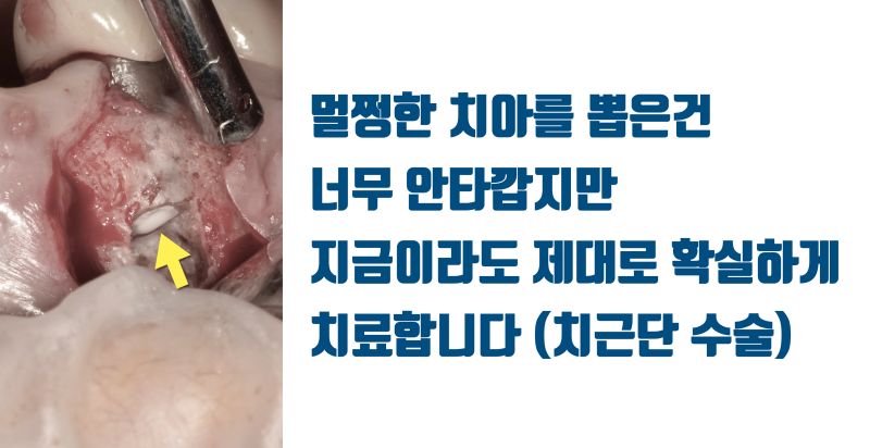 [최악의 치과 의료 사고] 판단 착오로 멀쩡한 치아를 발치한 사례 #재식술 #치아살리기 #최용훈원장 사진 4