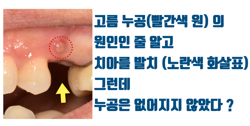 [최악의 치과 의료 사고] 판단 착오로 멀쩡한 치아를 발치한 사례 #재식술 #치아살리기 #최용훈원장 사진 2