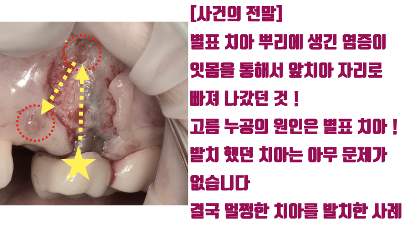 [최악의 치과 의료 사고] 판단 착오로 멀쩡한 치아를 발치한 사례 #재식술 #치아살리기 #최용훈원장