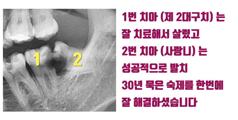 [치과 고통 공포증의 해결] 치과가 무서워서 30년동안 치과에 가지 못한 환자 #재식술 #치아재식술 #최용훈원장 사진 5