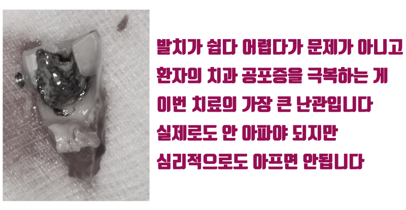 [치과 고통 공포증의 해결] 치과가 무서워서 30년동안 치과에 가지 못한 환자 #재식술 #치아재식술 #최용훈원장 사진 3