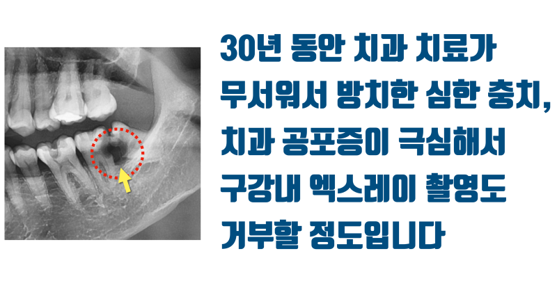 [치과 고통 공포증의 해결] 치과가 무서워서 30년동안 치과에 가지 못한 환자 #재식술 #치아재식술 #최용훈원장 사진 2