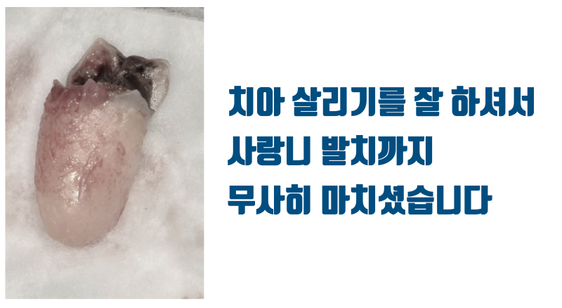 [치과 고통 공포증의 해결] 치과가 무서워서 30년동안 치과에 가지 못한 환자 #재식술 #치아재식술 #최용훈원장