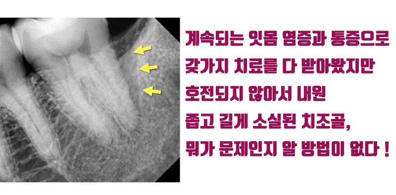 [치아의 숨겨진 비밀] 환자도 치과 의사도 고생 + 골탕만 먹는 이유 #재식술 #치아재식술 #최용훈원장 사진 2
