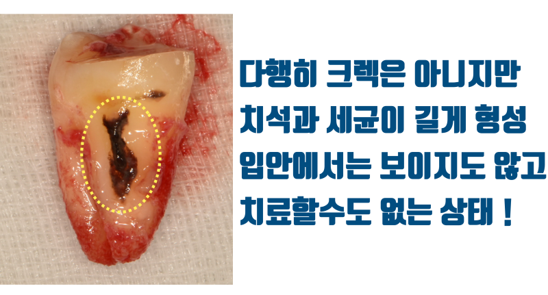 [치아의 숨겨진 비밀] 환자도 치과 의사도 고생 + 골탕만 먹는 이유 #재식술 #치아재식술 #최용훈원장