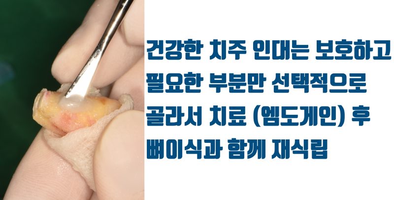 [치아의 숨겨진 비밀] 환자도 치과 의사도 고생 + 골탕만 먹는 이유 #재식술 #치아재식술 #최용훈원장 사진 5
