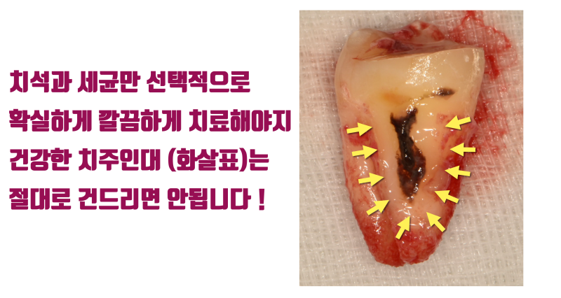 [치아의 숨겨진 비밀] 환자도 치과 의사도 고생 + 골탕만 먹는 이유 #재식술 #치아재식술 #최용훈원장 사진 4