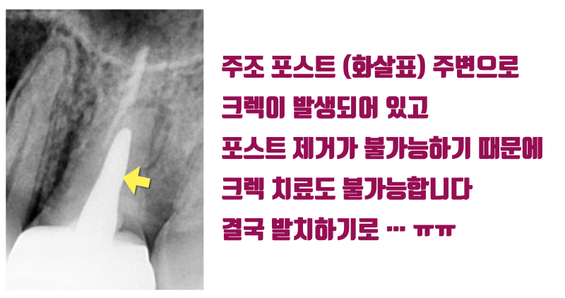 [구독자만 알고 계세요] 주조 포스트(casting post)는 될 수 있으면 안하시는게 좋습니다 #재식술 #최용훈원장