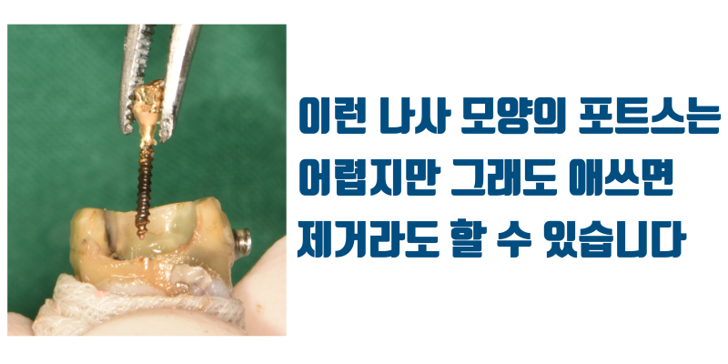 [구독자만 알고 계세요] 주조 포스트(casting post)는 될 수 있으면 안하시는게 좋습니다 #재식술 #최용훈원장 사진 2