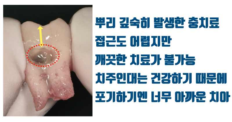 [가족의 치과 치료] 포기하기에는 아까운 부모님의 치아 #뿌리충치 #재식술 #최용훈원장 사진 2