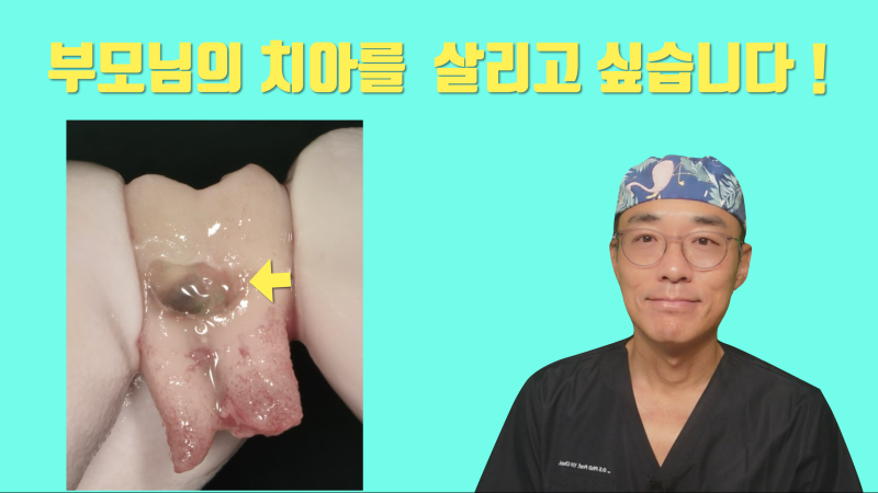 [가족의 치과 치료] 포기하기에는 아까운 부모님의 치아 #뿌리충치 #재식술 #최용훈원장