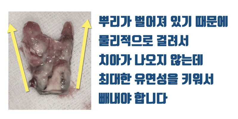 [신세 하소연] 이론적으로 발치가 불가능한 치아에 도전하는 이유 #재식술 #치아재식술 #최용훈원장