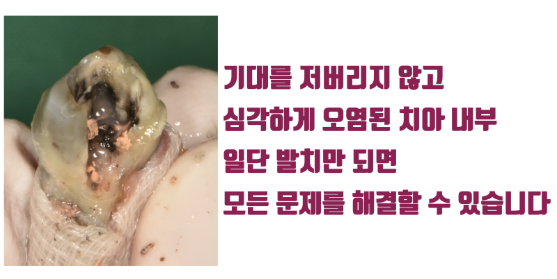 [신세 하소연] 이론적으로 발치가 불가능한 치아에 도전하는 이유 #재식술 #치아재식술 #최용훈원장 사진 3