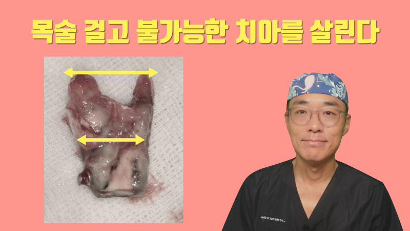 [신세 하소연] 이론적으로 발치가 불가능한 치아에 도전하는 이유 #재식술 #치아재식술 #최용훈원장