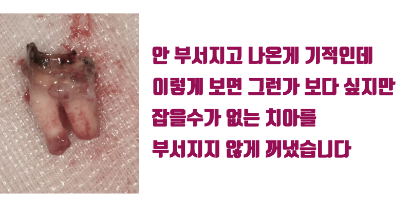 [해외 환자 재식술] 유럽에서 찾아온 환자, 시도라도 해 주세요 #재식술 #치아재식술 #최용훈원장