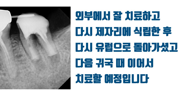 [해외 환자 재식술] 유럽에서 찾아온 환자, 시도라도 해 주세요 #재식술 #치아재식술 #최용훈원장 사진 4