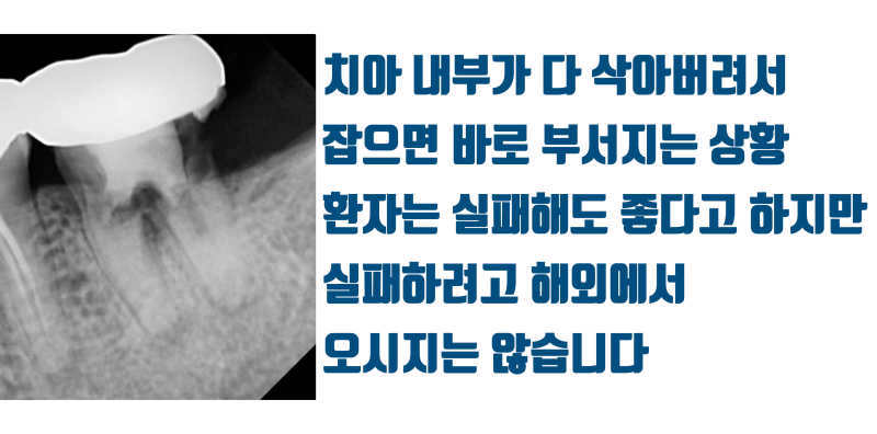 [해외 환자 재식술] 유럽에서 찾아온 환자, 시도라도 해 주세요 #재식술 #치아재식술 #최용훈원장 사진 2