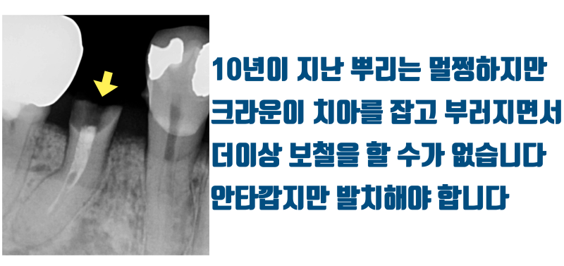 [화가 나는 증례] 애써 살려놓은 치아가 크라운 실패로 결국 발치하게 된 증례 #재식술 #치아살리기 #최용훈원장 사진 5