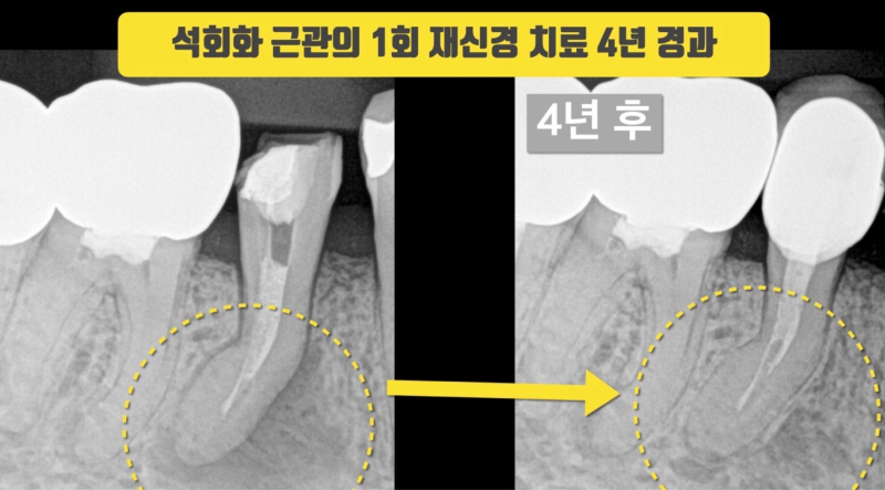 [화가 나는 증례] 애써 살려놓은 치아가 크라운 실패로 결국 발치하게 된 증례 #재식술 #치아살리기 #최용훈원장