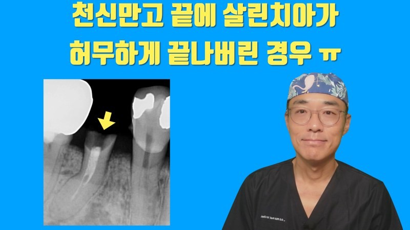 [화가 나는 증례] 애써 살려놓은 치아가 크라운 실패로 결국 발치하게 된 증례 #재식술 #치아살리기 #최용훈원장
