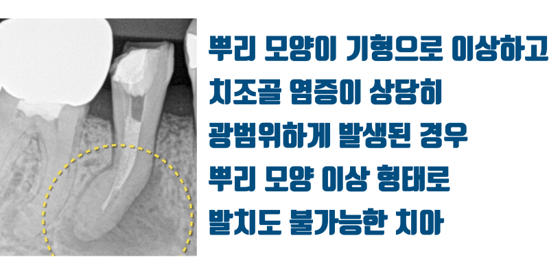 [화가 나는 증례] 애써 살려놓은 치아가 크라운 실패로 결국 발치하게 된 증례 #재식술 #치아살리기 #최용훈원장 사진 2