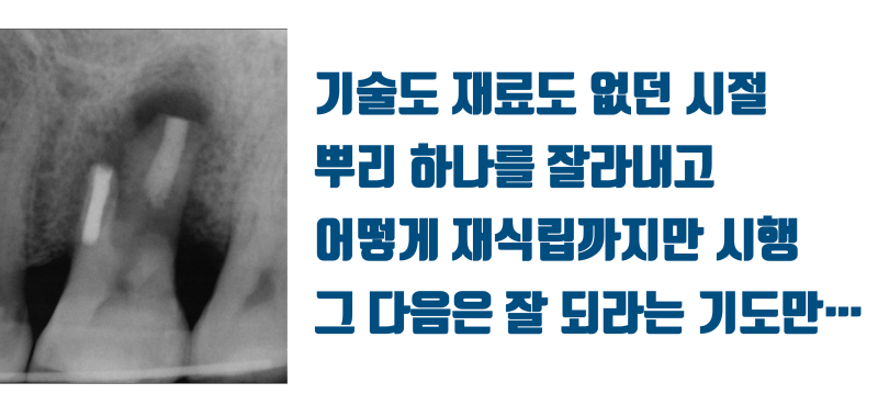 [이 맛에 치아살리기] 기술과 재료가 없어서 될대로 되라고 한 치아가 11년만에 돌아왔다 ! #재식술 #치아재식술 #최용훈원장 사진 4
