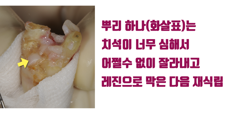 [이 맛에 치아살리기] 기술과 재료가 없어서 될대로 되라고 한 치아가 11년만에 돌아왔다 ! #재식술 #치아재식술 #최용훈원장 사진 3