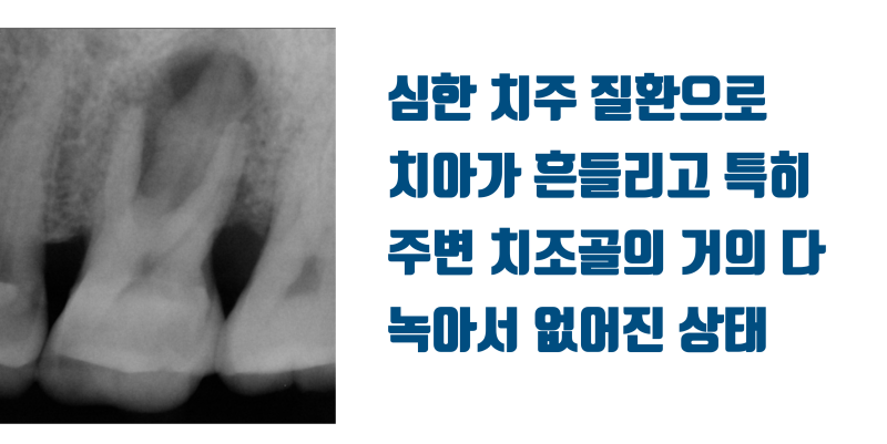 [이 맛에 치아살리기] 기술과 재료가 없어서 될대로 되라고 한 치아가 11년만에 돌아왔다 ! #재식술 #치아재식술 #최용훈원장