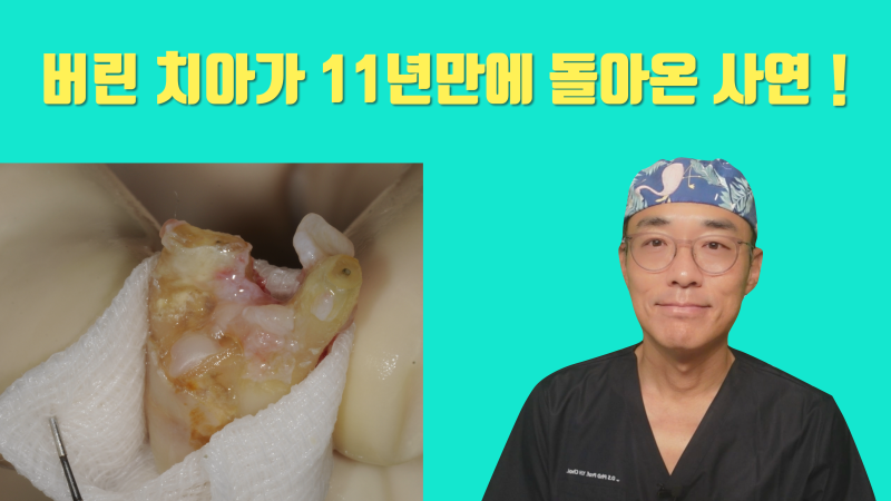 [이 맛에 치아살리기] 기술과 재료가 없어서 될대로 되라고 한 치아가 11년만에 돌아왔다 ! #재식술 #치아재식술 #최용훈원장