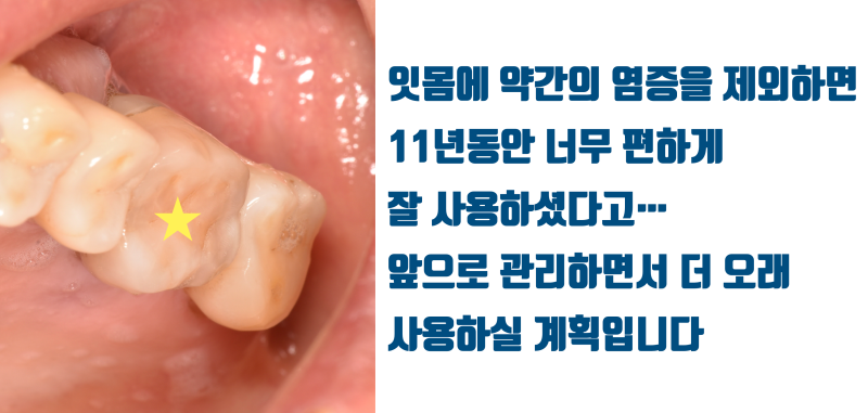 [이 맛에 치아살리기] 기술과 재료가 없어서 될대로 되라고 한 치아가 11년만에 돌아왔다 ! #재식술 #치아재식술 #최용훈원장 사진 6