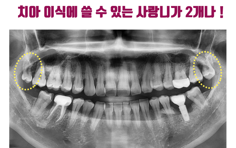 [임플란트 유감] 임플란트가 틀렸다 잘못되었다가 아닙니다 수많은 기회를 버린 환자가 안타까워서 포스팅합니다 #재식술 #치아살리기 #최용훈원장