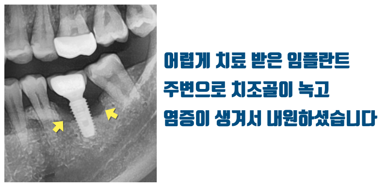 [임플란트 유감] 임플란트가 틀렸다 잘못되었다가 아닙니다 수많은 기회를 버린 환자가 안타까워서 포스팅합니다 #재식술 #치아살리기 #최용훈원장 사진 2