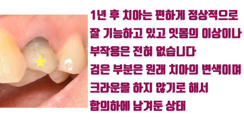 [가슴 벅찬 치아살리기] 완전히 쪼개진 치아를 살렸다! #재식술 #치아재식술 #최용훈원장 사진 5