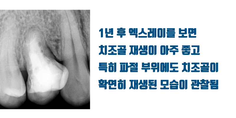 [가슴 벅찬 치아살리기] 완전히 쪼개진 치아를 살렸다! #재식술 #치아재식술 #최용훈원장 사진 6