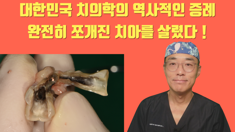 [가슴 벅찬 치아살리기] 완전히 쪼개진 치아를 살렸다! #재식술 #치아재식술 #최용훈원장